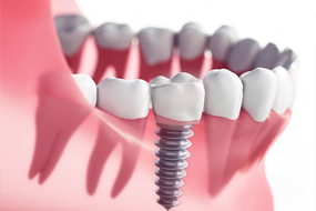 https://suranadentalclinic.com/wp-content/uploads/2021/12/Dental-Implants.png