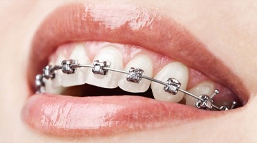 Dental Implants In Indore