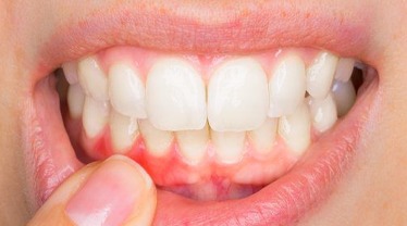https://suranadentalclinic.com/wp-content/uploads/2022/01/Pus-and-Swelling-dental_72_11zon.jpg