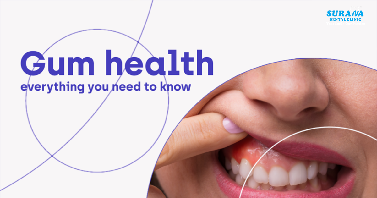 Gum Health - Best Dentist Vijay Nagar