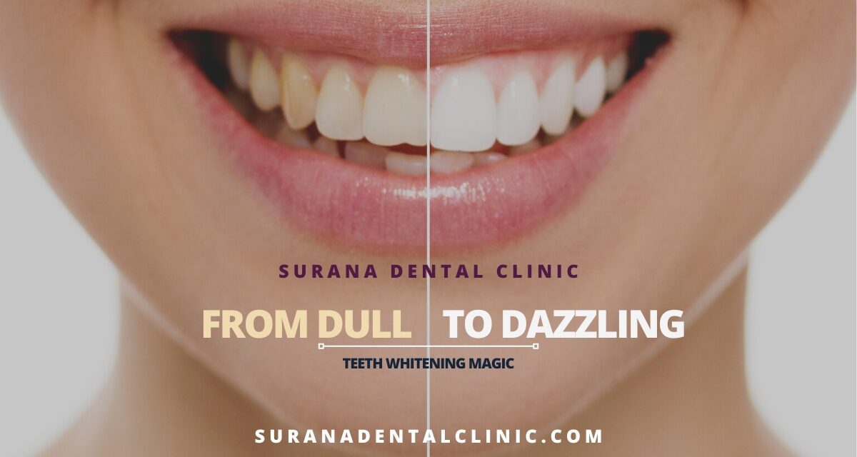 https://suranadentalclinic.com/wp-content/uploads/2023/09/From-Dull-to-Dazzling-Teeth-Whitening-Magic-1200x640.jpg