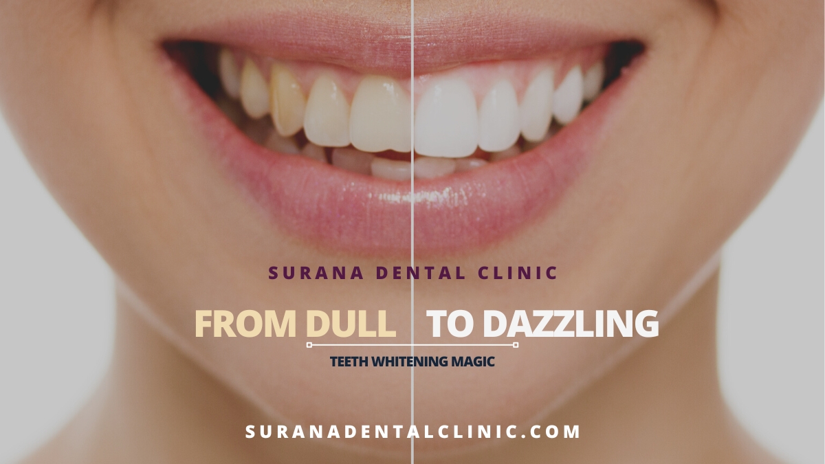 From Dull to Dazzling Teeth Whitening Magic