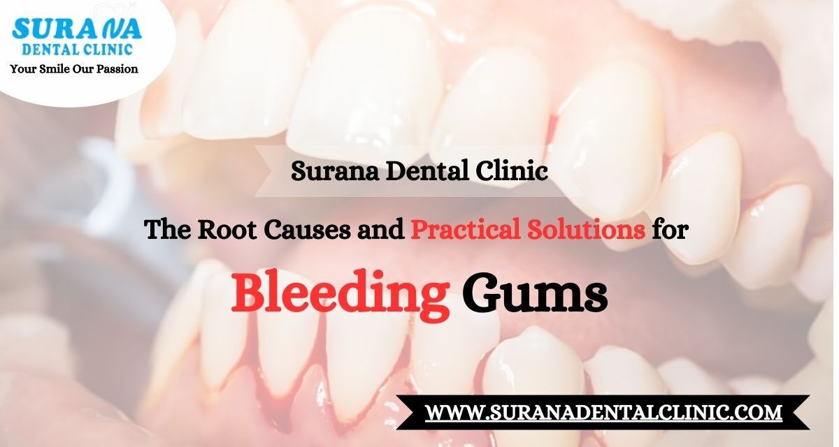 https://suranadentalclinic.com/wp-content/uploads/2023/12/The-Root-Causes-and-Practical-Solutions-for-Bleeding-Gums-2-1200x640.jpg