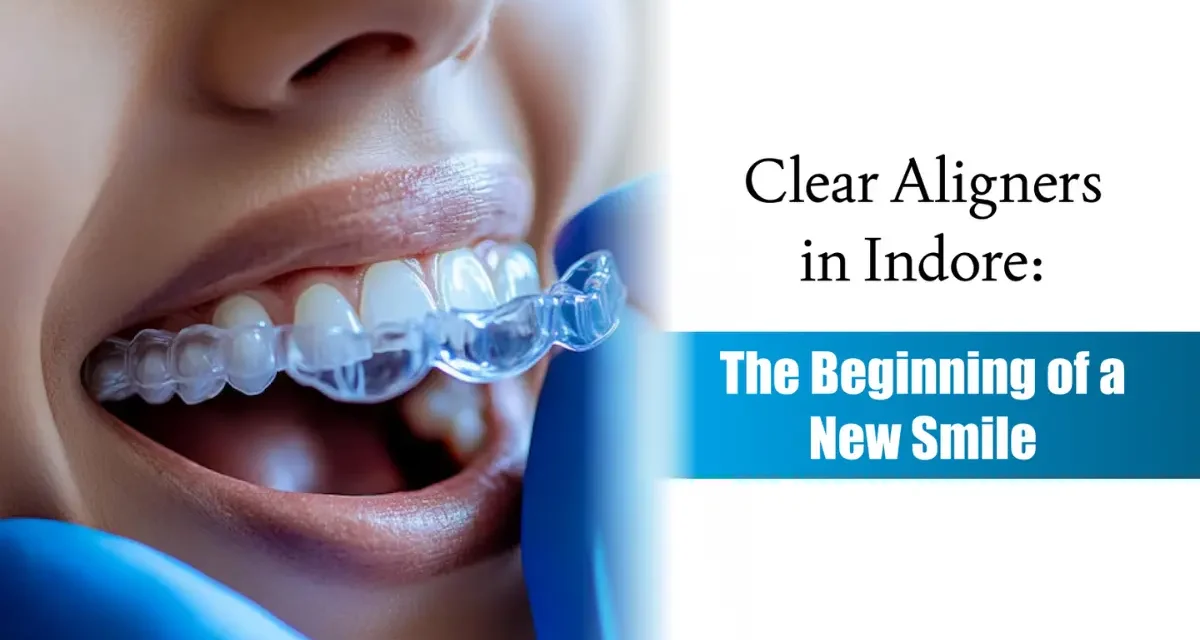 Clear Aligners in Indore: The Beginning of a New Smile