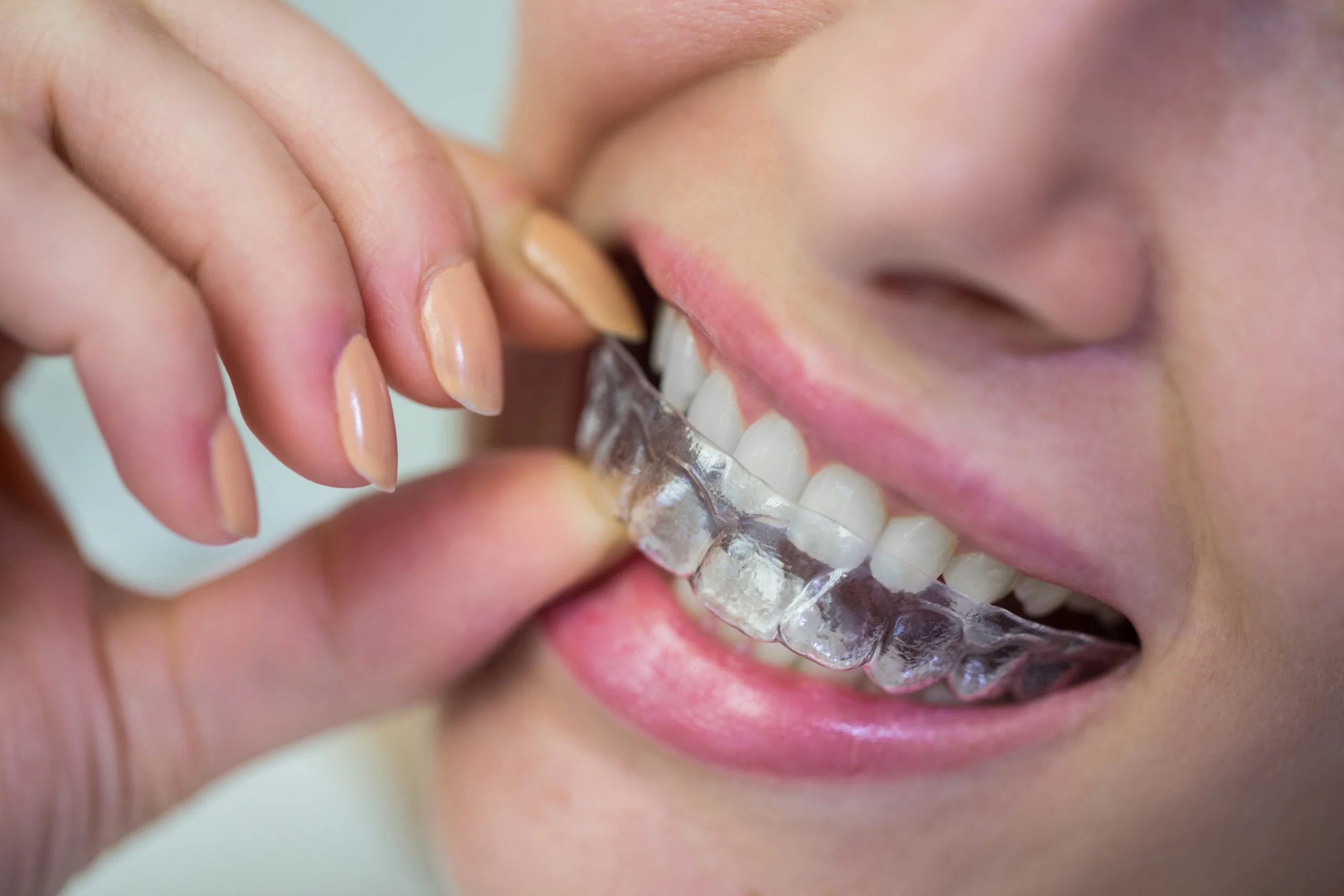 clear aligners treatment at Surana Dental Clinic