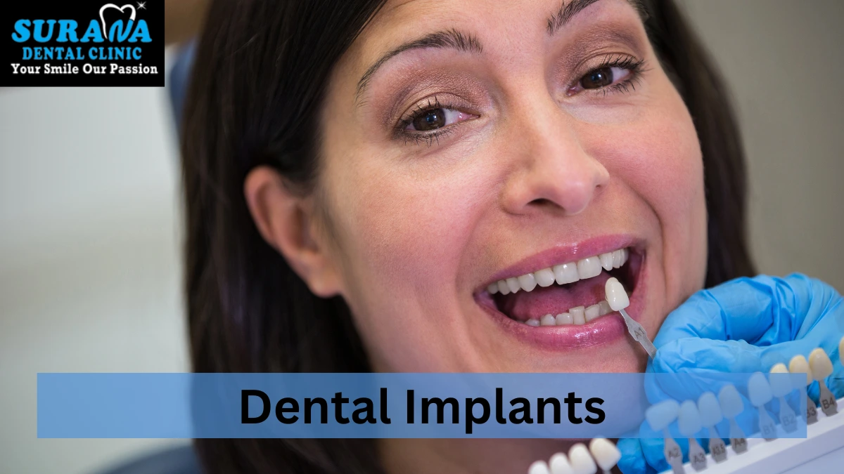 Dental Implants