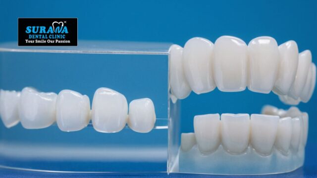 Do clear aligners really work to straighten teeth