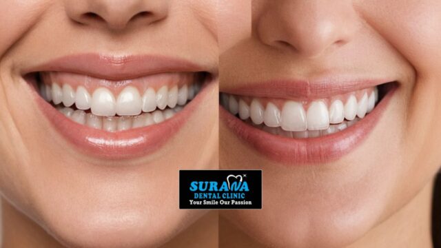 before and after comparison of a patient’s smile transformation using clear aligners - dental clinic in indore