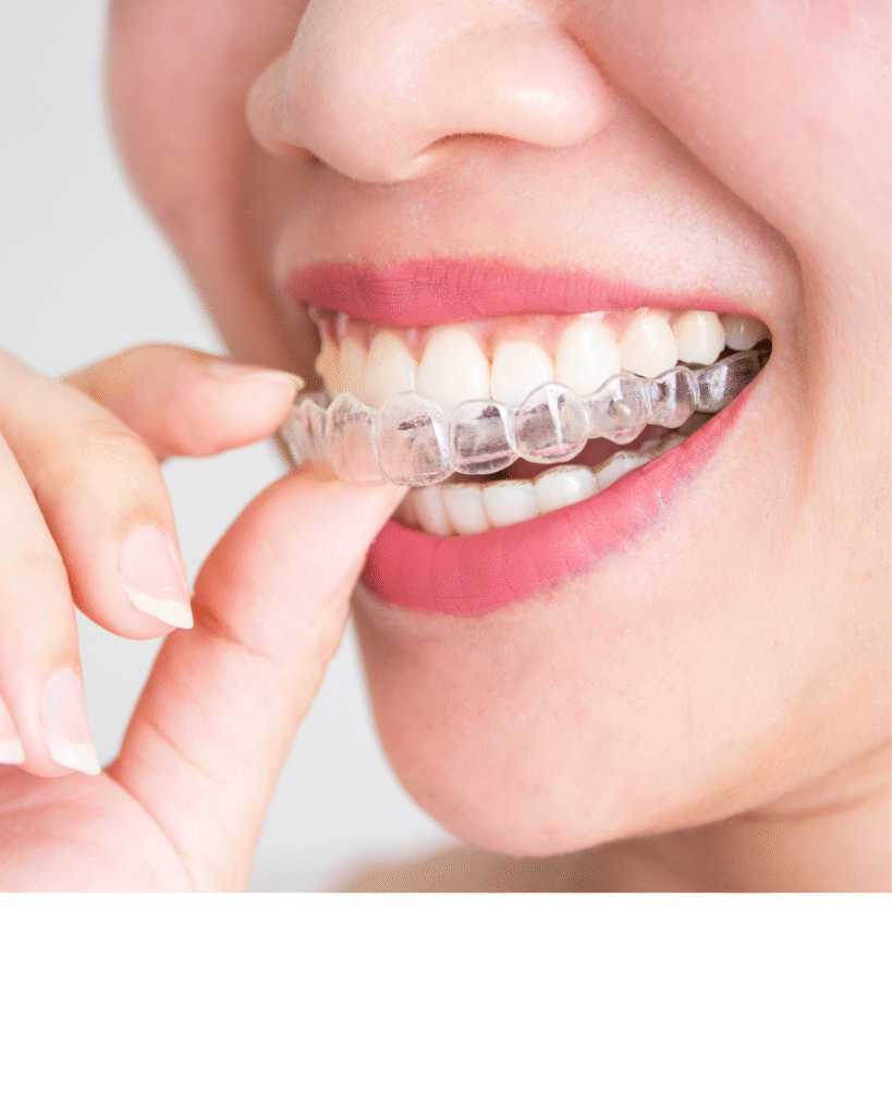 Invisible Braces