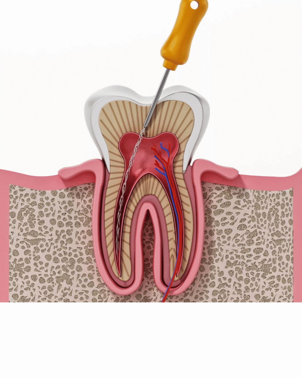 Painless Root Canal Treatment