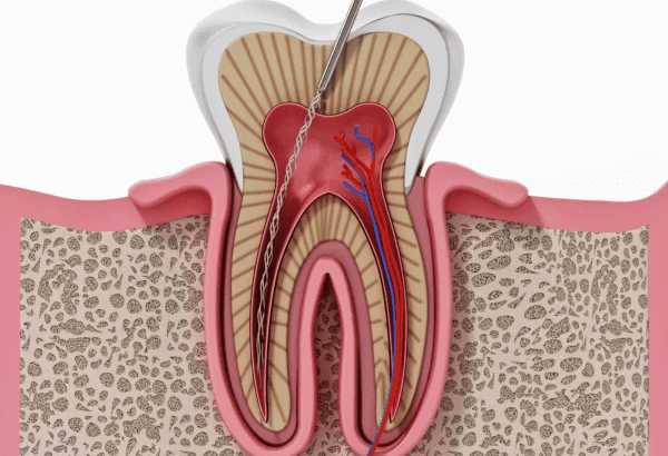 Painless Root Canal Treatment