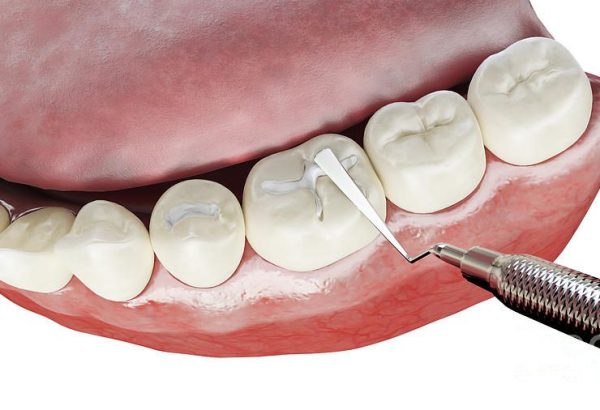 1-dental-filling-