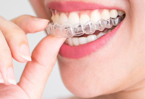 Invisible Braces