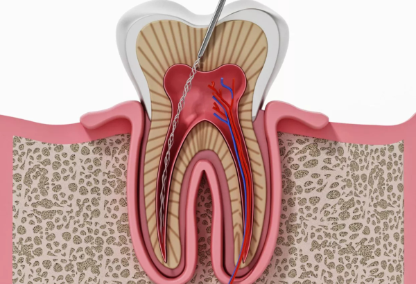 Painless Root Canal Treatment
