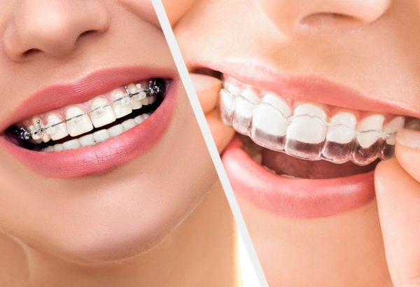 braces-and-aligners