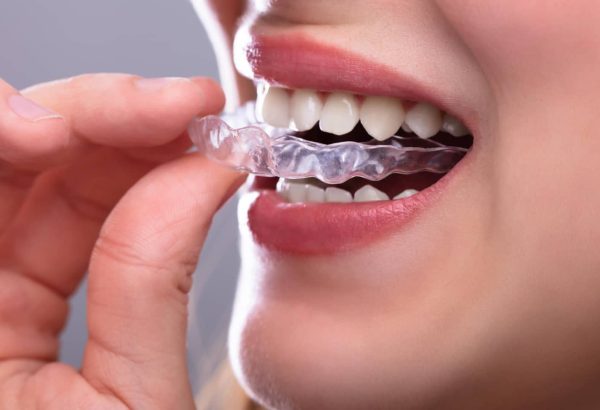 dental-aligner
