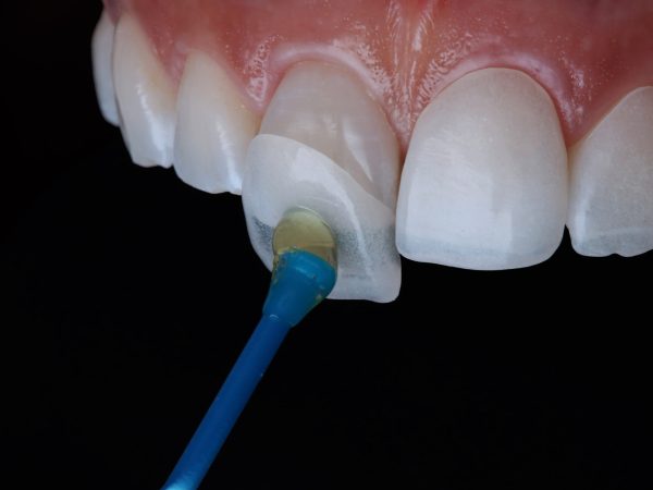 Dental Veneers