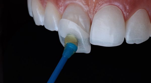 dentlveneers