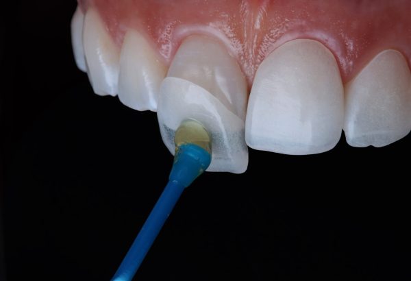 dentlveneers