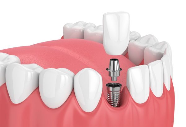 dorset-implants-1-1140x855