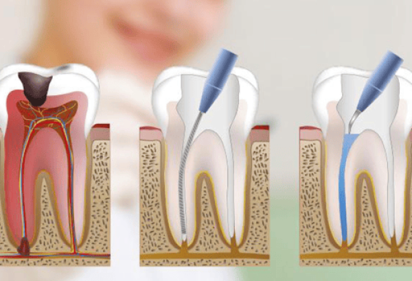 rootCanal
